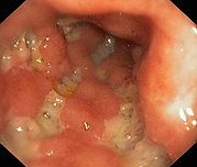 Morbus Crohn
                Darmentz�ndung
