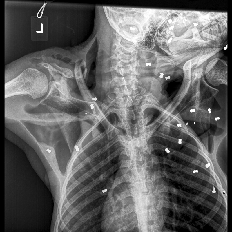 Indonesien: Orang Utan mit
Gewehrkugeln im Körper, Röntgenfoto Indonesien: Orang Utan mit
Gewehrkugeln im Körper, Röntgenfoto