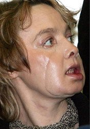 La mujer Isabelle Dinoire (38
                                    a�os) de Valenciennes (Francia) fue
                                    atacado por su mezcla Labrador y
                                    recibi� la primer transplantaci�n de
                                    cara del mundo [99]