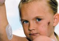 Das M�dchen Amber Churm aus
                                    Thurnscoe in der Provinz South Yorks
                                    in England zeigt ihre Verletzungen
                                    im Gesicht und am Arm, die von einem
                                    aggressiven Staffordshire Bull
                                    Terrier stammen [70]