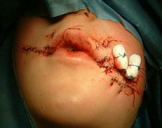 Stacheldraht-Verletzung,
                    genht: Ein Rodler verfehlte eine Kurve und wurde in
                    einen Stacheldraht geschleudert, Unterammergau,
                    8.1.2005.