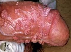 des verrues condylomes sur le p�nis