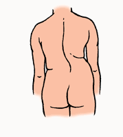 Escoliosis (curvatura de la columna
                            vertebral) debido a un exceso de tensi�n
                            unilateral con los instrumentos musicales en
                            una posici�n no central: as� sale con el
                            viol�n, con la viola, con la flauta, con
                            fagot, etc.