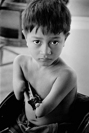 da�os gen�ticos por Agent Orange, faltan brazos