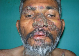 S�filis en la cara