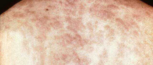 S�filis negra en
              la espalda