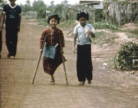 Minenopfer: Mdchen mit nur einem
                  Bein in Asien (Region Kambodscha, Burma und Laos)