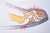 Krallenzehe, Schema mit Angabe der
                          Hornhautbildung (unten) und der Bildung von
                          Hühneraugen (oben)