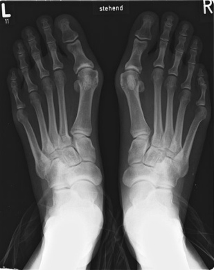 Die Fussverstümmelung eines
                                  Spreizfuss mit Schiefzehe (Hallux
                                  valgus), hier an einem Röntgenfoto
                                  sichtbar
