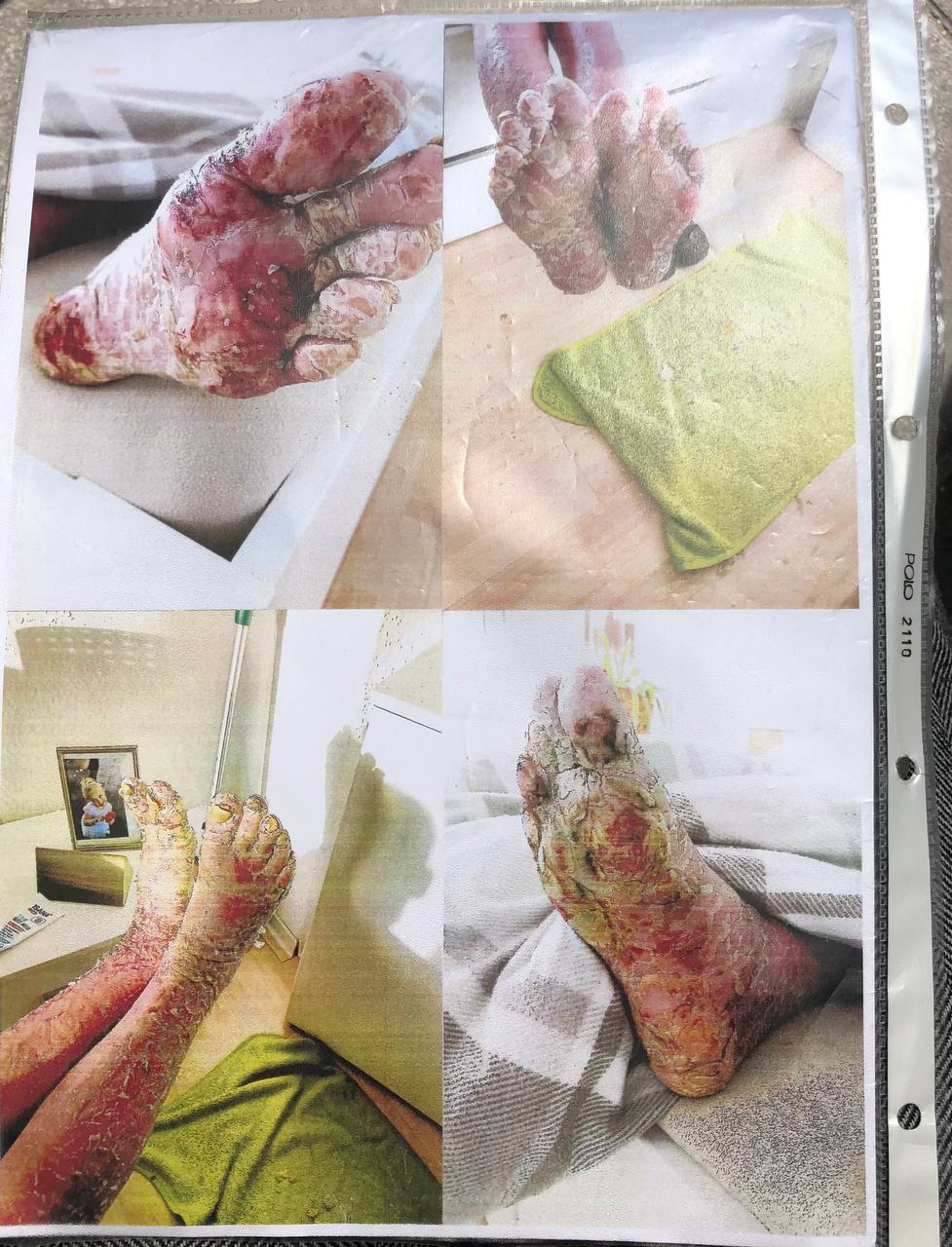 SCHLANGENGIFTimpfschaden Magdeburg
27.5.2022: Mann Pfizer geimpft: 2
Schlaganfälle + Haut löst sich auf SCHLANGENGIFTimpfschaden Magdeburg
27.5.2022: Mann Pfizer geimpft: 2
Schlaganfälle + Haut löst sich auf