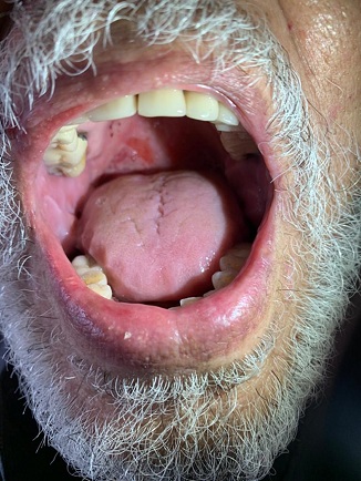 Hautsch�den durch SCHLANGENGIFTimpfung in
                  Kalifornien ("USA") 4.6.2022: 5 F�lle 01