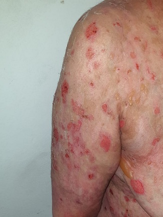 Hautsch�den durch SCHLANGENGIFTimpfung in
                  Kalifornien ("USA") 4.6.2022: 5 F�lle 3b