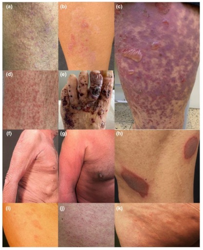 SCHLANGENGIFTimpfschaden
Brasilien 6.6.2022: Hautschäden -
Beispiele SCHLANGENGIFTimpfschaden
Brasilien 6.6.2022: Hautschäden -
Beispiele