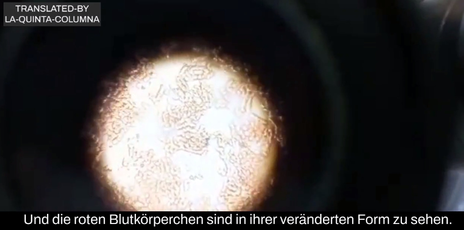 Geimpfte Person wahrsch. aus Argentinien:
Blutprobe unter dem Mikroskop, Blutschaden
gestapelte rote Blutkörperchen und Fremdkörper im
Blut 2 Geimpfte Person wahrsch. aus
Argentinien: Blutprobe unter dem Mikroskop,
Blutschaden gestapelte rote Blutkörperchen und
Fremdkörper im Blut 2