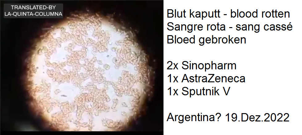 Blutschaden in Argentinien 18.12.2022:
Person 4x geimpft: Blutkörperchen kleben
aneinander+Fremdkörper Blutschaden in
Argentinien 18.12.2022: Person 4x geimpft:
Blutkörperchen kleben aneinander+Fremdkörper