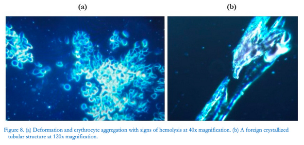 Blutschaden durch "Coronaimpfung"
in GB: Zusammenballung+Zerstörung roter
Blutkörperchen (links), kristallisierte Struktur
(rechts) Blutschaden durch
"Coronaimpfung" in GB:
Zusammenballung+Zerstörung roter Blutkörperchen
(links), kristallisierte Struktur (rechts)