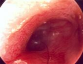 Entz�ndungen (hier
                        eine Entz�ndung des Geh�rgangs) werden durch
                        eine Ern�hrung gegen die Blutgruppe sehr
                        beg�nstigt