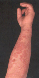 Psoriasis es provocada
                      por la alimentaci�n contra el grupo sangu�neo,
                      sobre todo con el grupo sangu�neo 0.