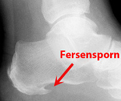 Innerer Fernsensporn, R�ntgenfoto