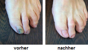 Alte
                    Fussn�gel und geschliffene Fussn�gel,
                    Vorher-Nachher-Foto