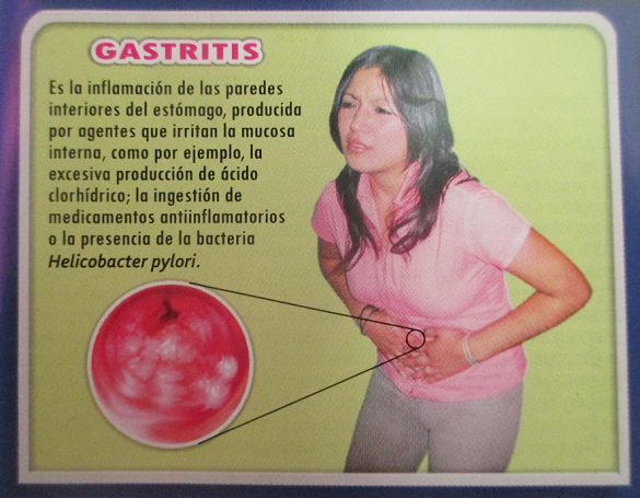 Enfermedad del
                            aparato digestivo: gastritis, inflamación de
                            las paredes interiores del estómago
