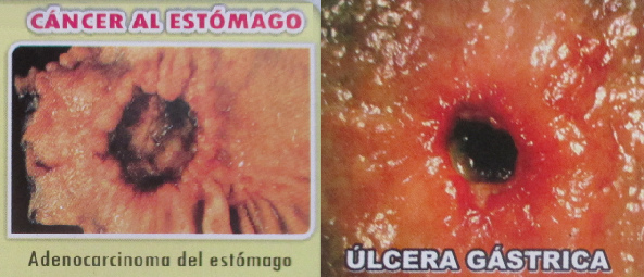 Enfermedad del aparato
                            digestivo: cáncer en cualquier lugar