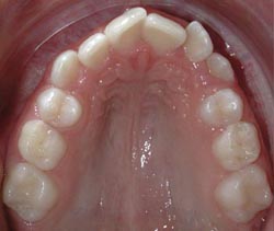 Engstand bei einem
Unterkiefer, eine Sicht von oben Engstand bei einem Unterkiefer, eine
Sicht von oben