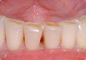 Durch Z�hneknirschen (Bruxismus)
                            abgeschliffene Schneidez�hne sehen so aus