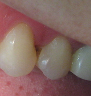 La caries alazana entre los
                                  dientes ataca dos dientes de un
                                  camino. As� va ser cuando no se tiene
                                  ninguna idea y rechaza a la prevenci�n
                                  con hilo de higiene dental o de una
                                  higienista dental. El ejemplo es una
                                  cliente de dientes del Per� (2009).