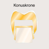 Corona: La corona de cono es un desarrollo
                        ulterior de la corona de telescopio con una
                        forma c�nica [28].