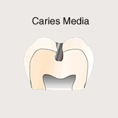 Caries media, esquema [4]. La caries del
                          surco avanz� m�s en su profundidad [6]. El
                          tratamiento (mandrilar el lugar de caries,
                          quitar la caries a m�quina) va ser sin dolor
                          [4]