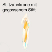Corona de diente de espina ("diente
                          de espina", corona de espina, corona
                          Richmond, corona Logan) para dientes incisivos
                          con espina fundida [34]