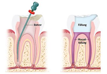 Tratamiento de la
                        ra�z (imagen) [42]