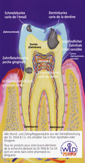 Zahnaufbau mit Kariesarten, Schema